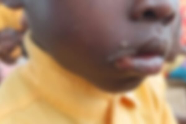 Oti fishing village pleads for health team as sores keep children out of school